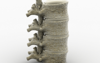 spinal fusion model human spine