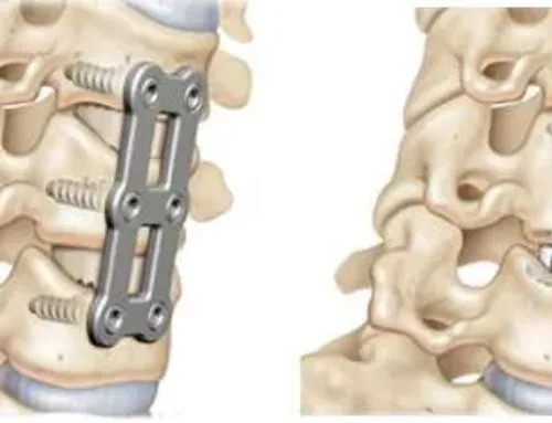 Dr. Zaslavsky Explores the Benefits of Mobi-C